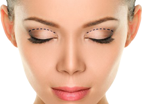 eyelid surgery abroad