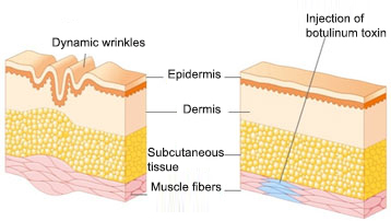 Botulinum-toxin-Mechanism-Action