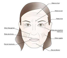 Facial-wrinkles-Botox