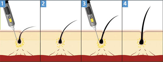 PRP-Hair-scalp-Injections