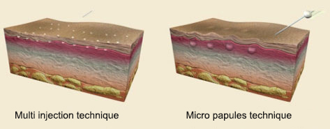 PRP-injection-techniques