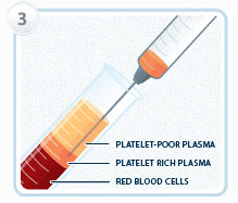 Platelet-Rich-Plasma-extraction