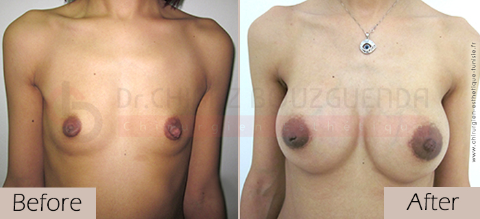 breast-augmentation-before-after-abroad-tunisia-patient3