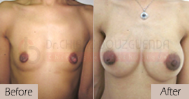 breast-augmentation-before-after-abroad-tunisia-patient3
