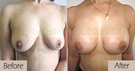 breast-augmentation-before-after-abroad-tunisia-patient4