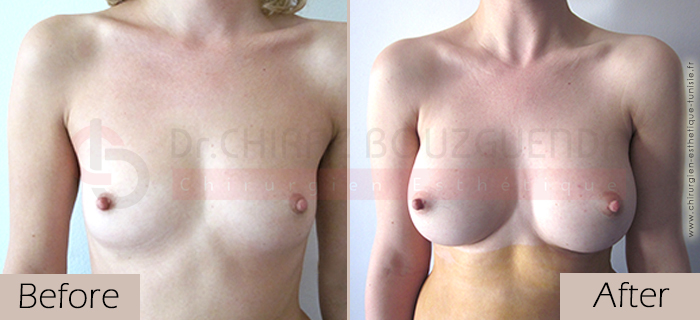 breast-augmentation-before-after-abroad-tunisia-patient5