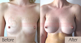 breast-augmentation-before-after-abroad-tunisia-patient5