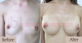 breast-augmentation-before-after-abroad-tunisia-patient6