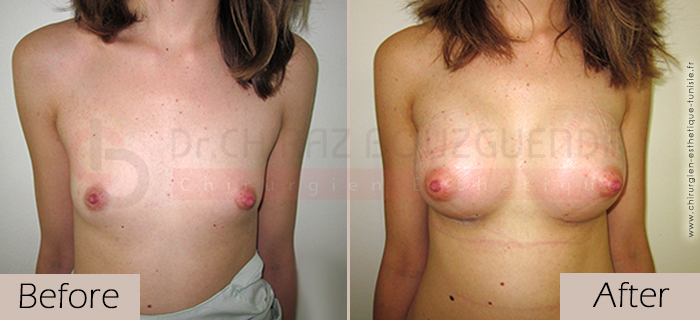 breast-augmentation-before-after-abroad-tunisia-patient7