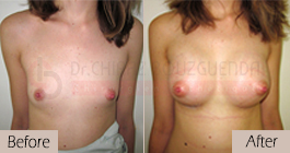 breast-augmentation-before-after-abroad-tunisia-patient7