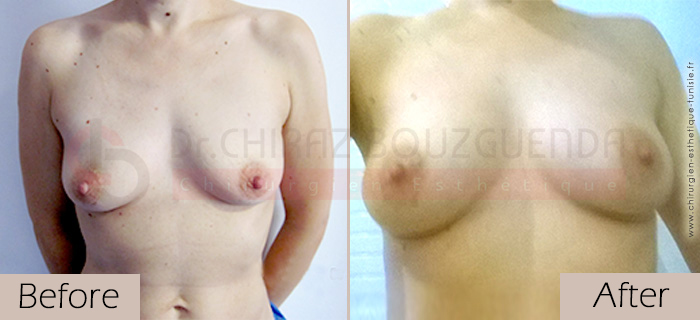 Breast-fat-transfer-before-after-abroad-tunisia-patient2