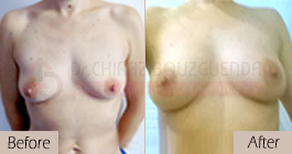 Breast-fat-transfer-before-after-abroad-tunisia-patient2