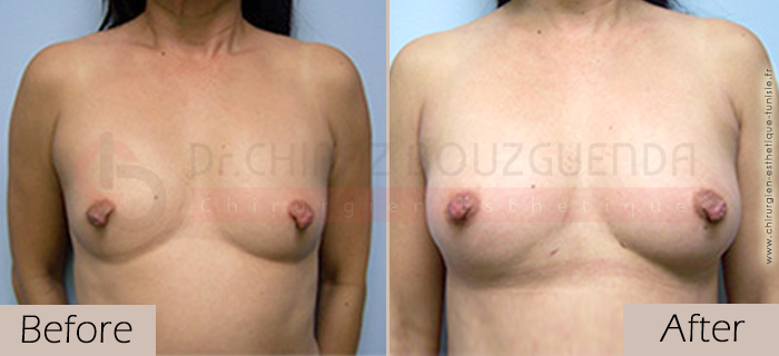 Breast-fat-transfer-before-after-abroad-tunisia-patient3