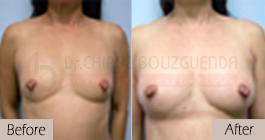 Breast-fat-transfer-before-after-abroad-tunisia-patient3