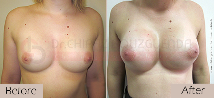 Breast-implants-before-after-abroad-tunisia-patient1