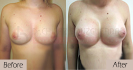 Breast-implants-before-after-abroad-tunisia-patient1