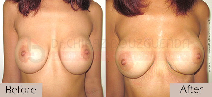 Breast-implants-before-after-abroad-tunisia-patient3