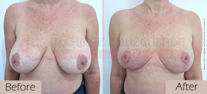 Breast lift-before-abroad-tunisia-patient1