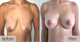 Breast lift-before-abroad-tunisia-patient1