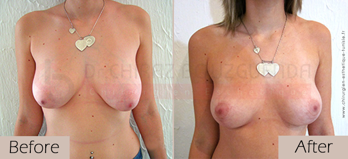 Breast lift-before-abroad-tunisia-patient2