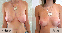 Breast lift-before-abroad-tunisia-patient2