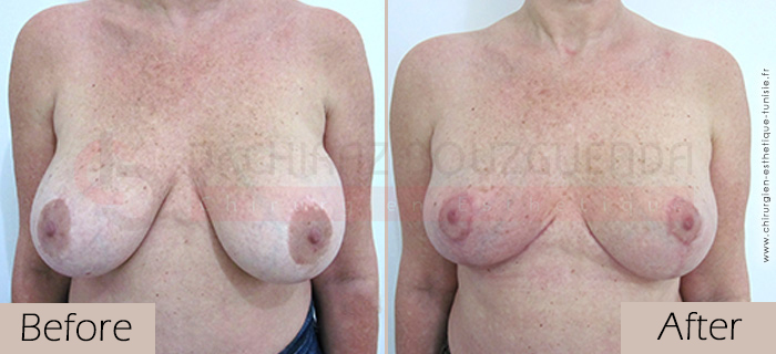 Breast lift-before-abroad-tunisia-patient3