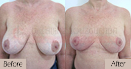 Breast lift-before-abroad-tunisia-patient3