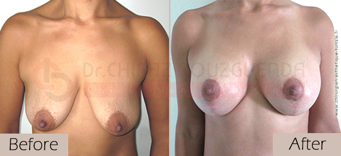 Breast lift-before-abroad-tunisia-patient4