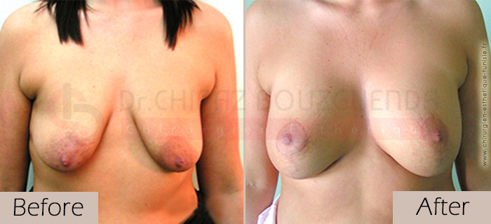 Breast lift-before-abroad-tunisia-patient5