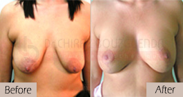 Breast lift-before-abroad-tunisia-patient5