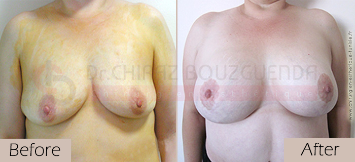 Breast lift-before-abroad-tunisia-patient6