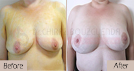 Breast lift-before-abroad-tunisia-patient6