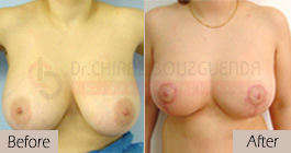 Breast-reduction-before-after-abroad-tunisia-patient1