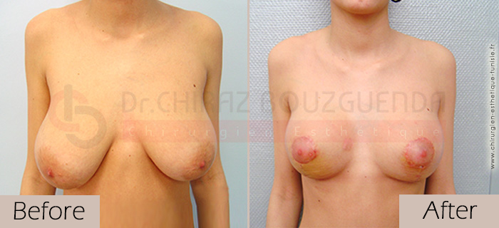 Breast-reduction-before-after-abroad-tunisia-patient2