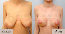 Breast-reduction-before-after-abroad-tunisia-patient2