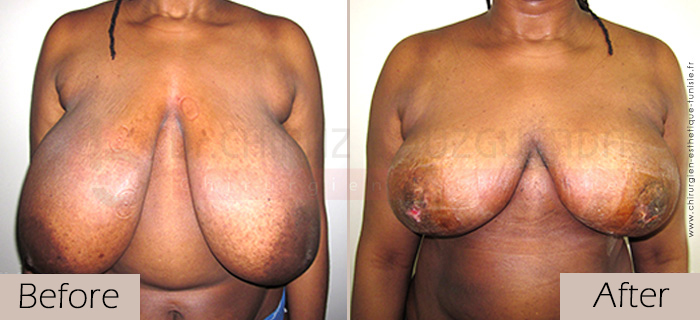 Breast-reduction-before-after-abroad-tunisia-patient3