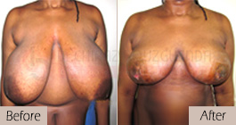 Breast-reduction-before-after-abroad-tunisia-patient3