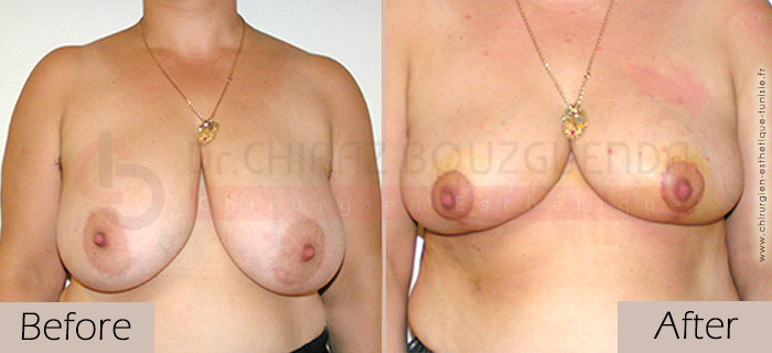 Breast-reduction-before-after-abroad-tunisia-patient5