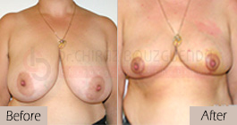 Breast-reduction-before-after-abroad-tunisia-patient5