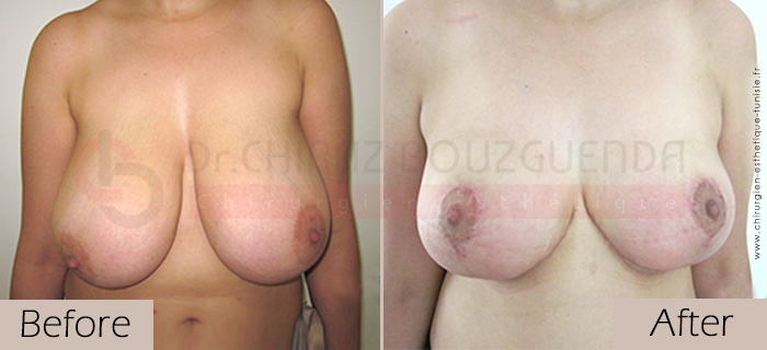 Breast-reduction-before-after-abroad-tunisia-patient6