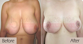 Breast-reduction-before-after-abroad-tunisia-patient6