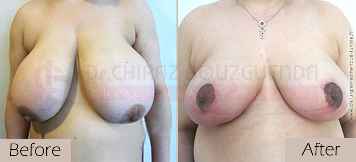 Breast-reduction-before-after-abroad-tunisia-patient7