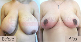 Breast-reduction-before-after-abroad-tunisia-patient7