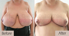 Breast-reduction-before-after-abroad-tunisia-patient8