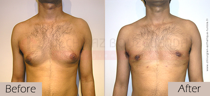 Gynecomastia-before-after-face-abroad-tunisia-patient1