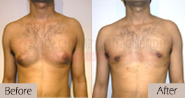 Gynecomastia-before-after-face-abroad-tunisia-patient1