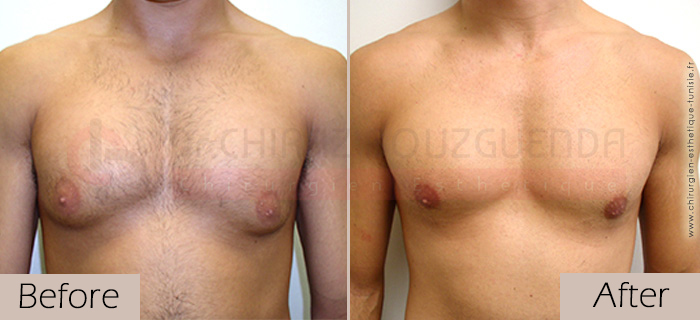 Gynecomastia-before-after-face-abroad-tunisia-patient2