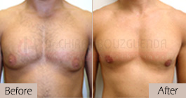 Gynecomastia-before-after-face-abroad-tunisia-patient2