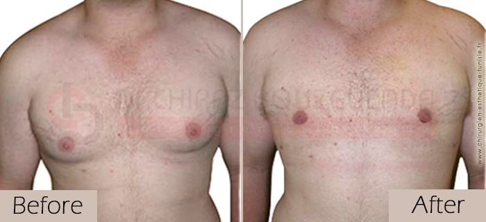 Gynecomastia-before-after-face-abroad-tunisia-patient4