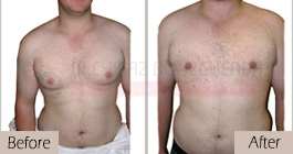 Gynecomastia-before-after-face-abroad-tunisia-patient4